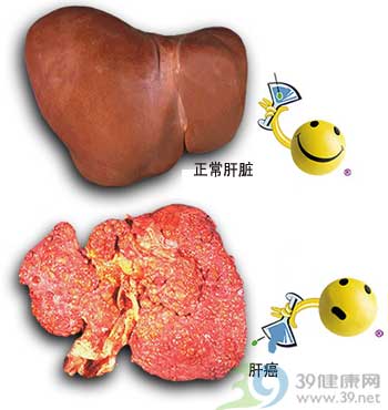 王桂绵解读:晚期肝癌的综合治疗