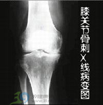从病因预防骨质疏松